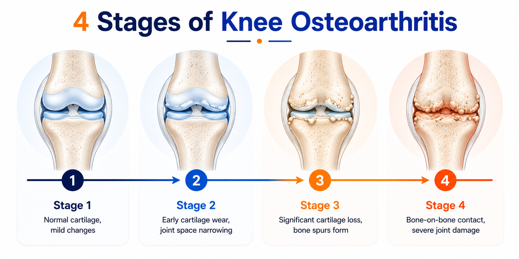 Stages of Knee osteoarthritis