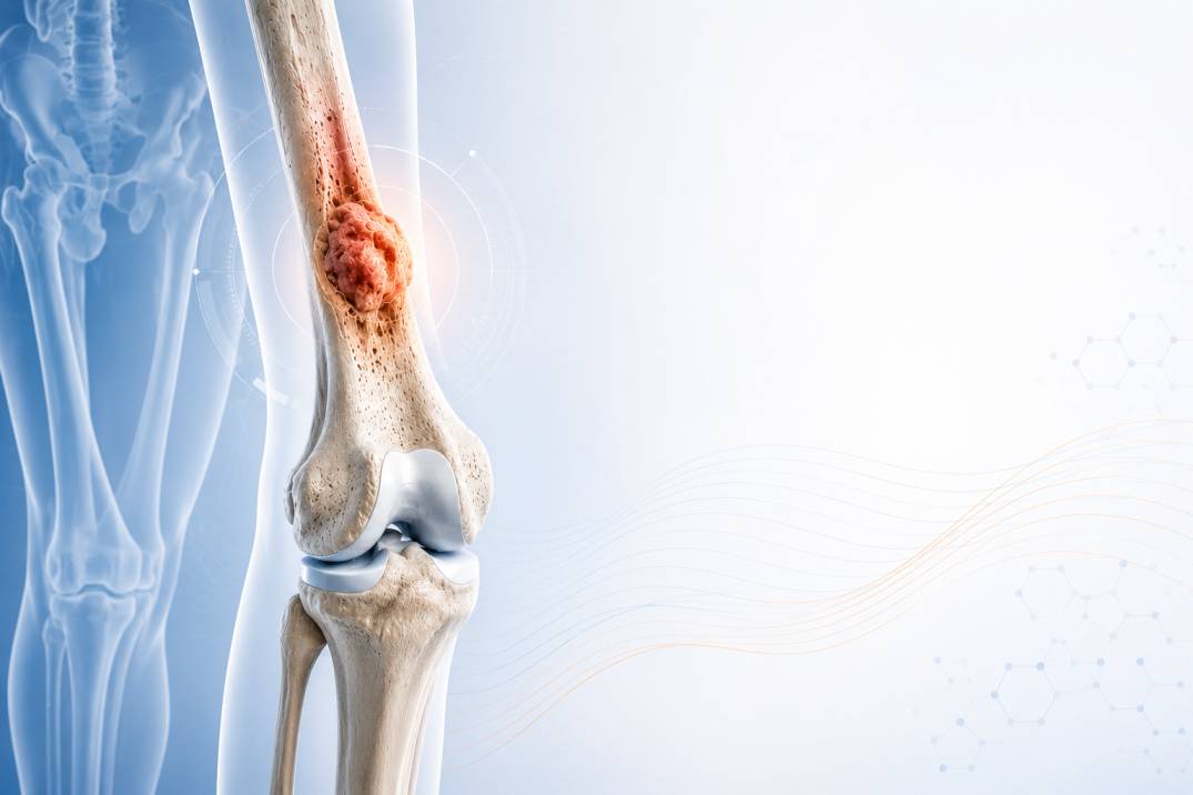Bone Tumour Treatment in Gurgaon