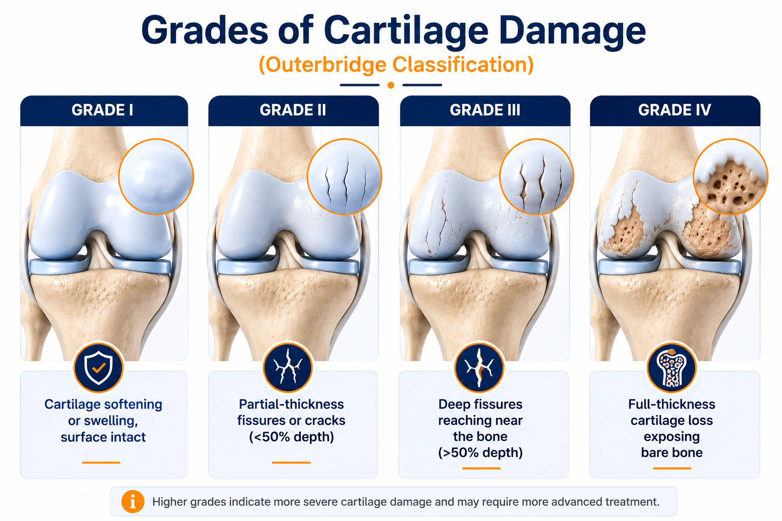 Grades of Cartilage Damage