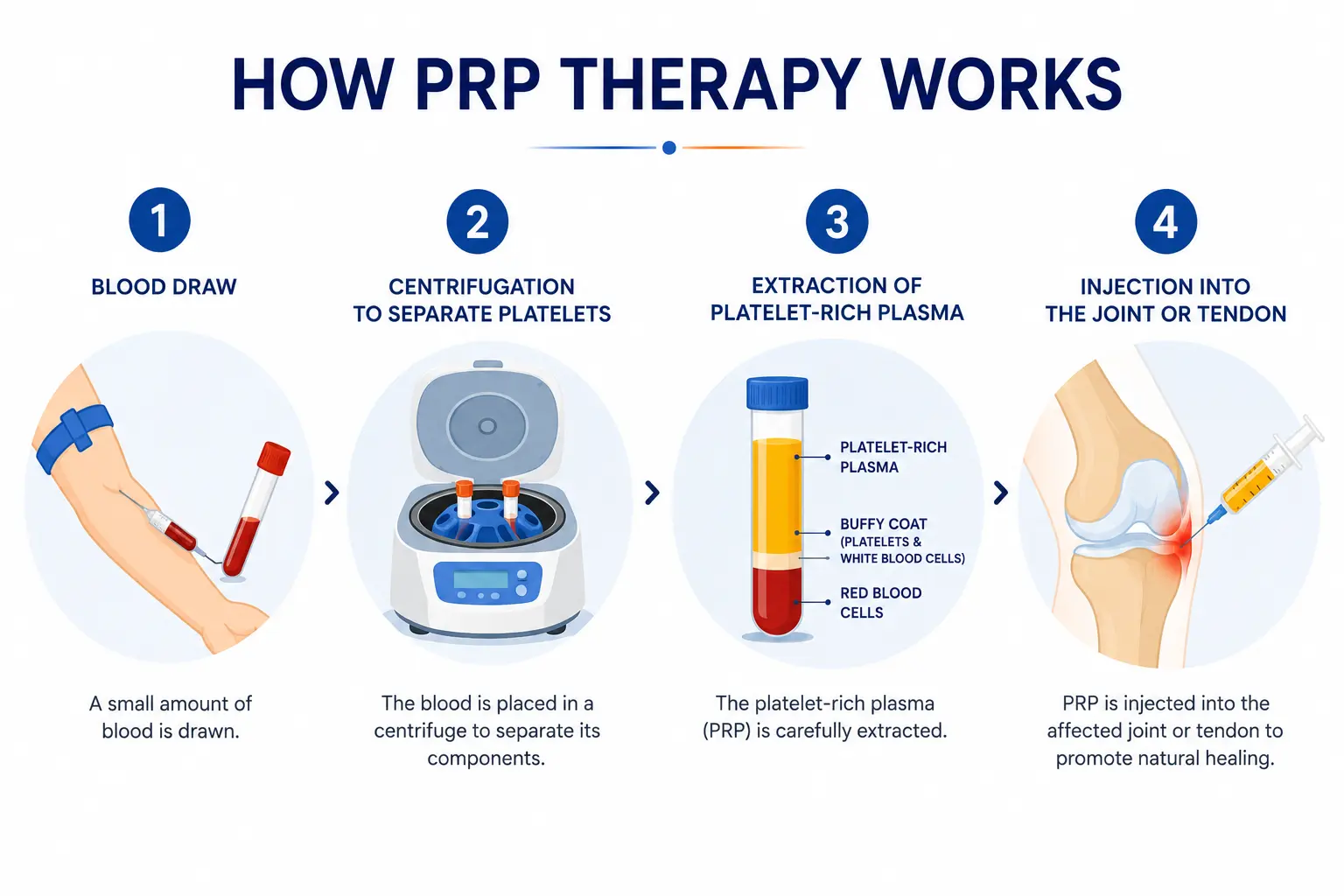 4-step PRP therapy process infographic - from blood draw to joint injection