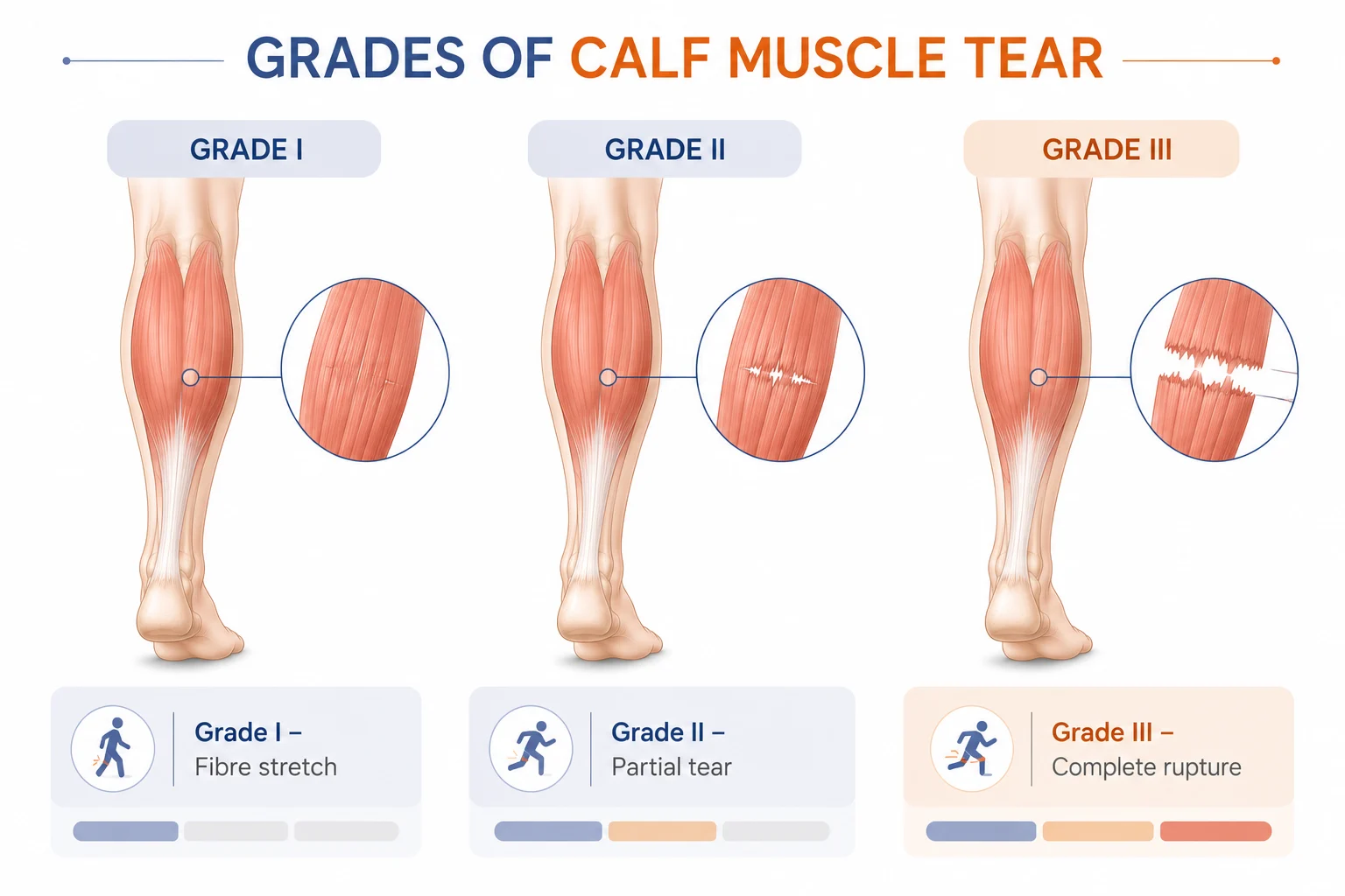 Inforgraphic showing grades of Calf muscle tear. Grade 1 calf muscle tear, Grade 2 calf muscle tear, and Grade 3 calf muscle tear.