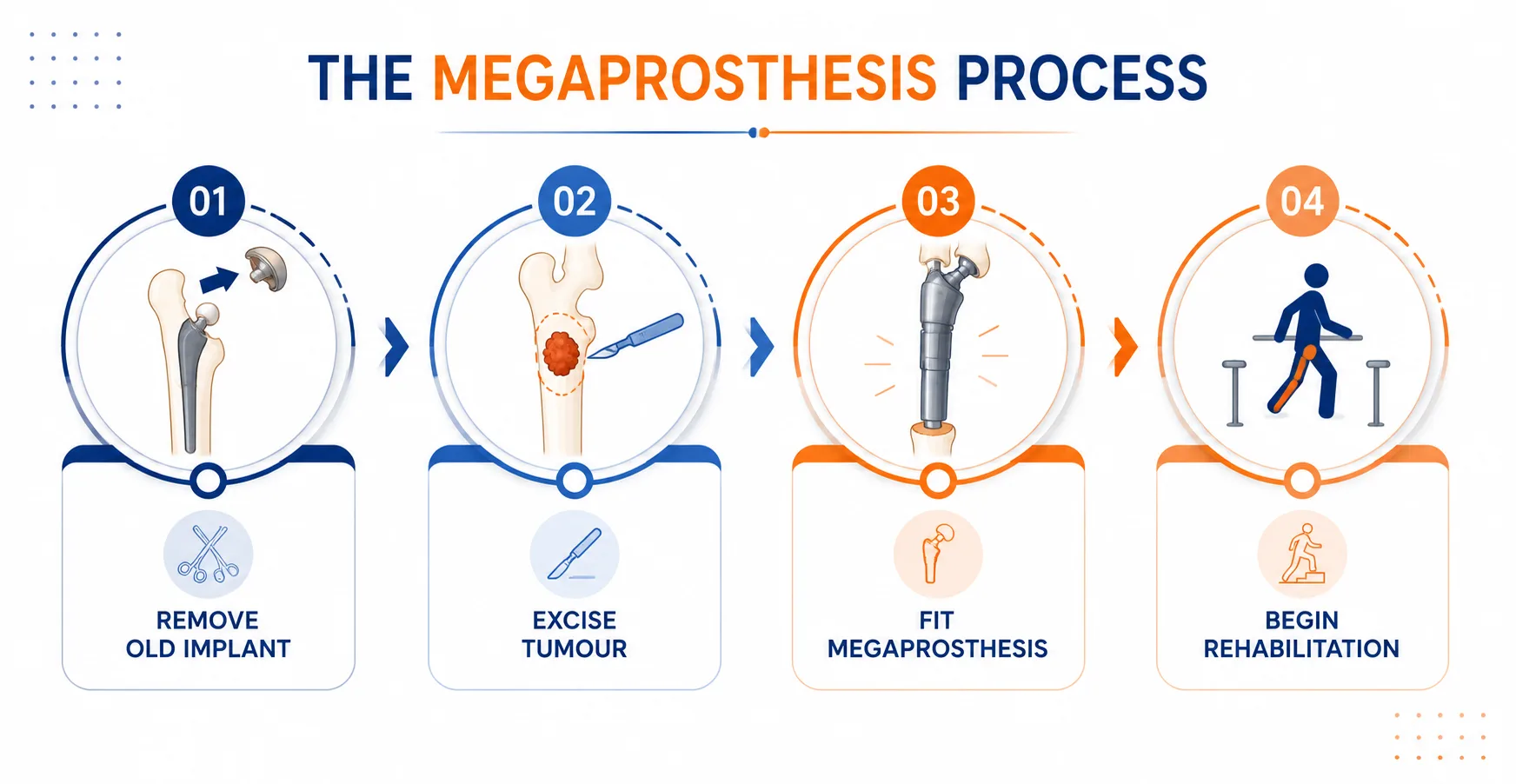 Infographic showing the four key steps of limb salvage megaprosthesis surgery. Limb Salvage surgery procedure in Delhi NCR.