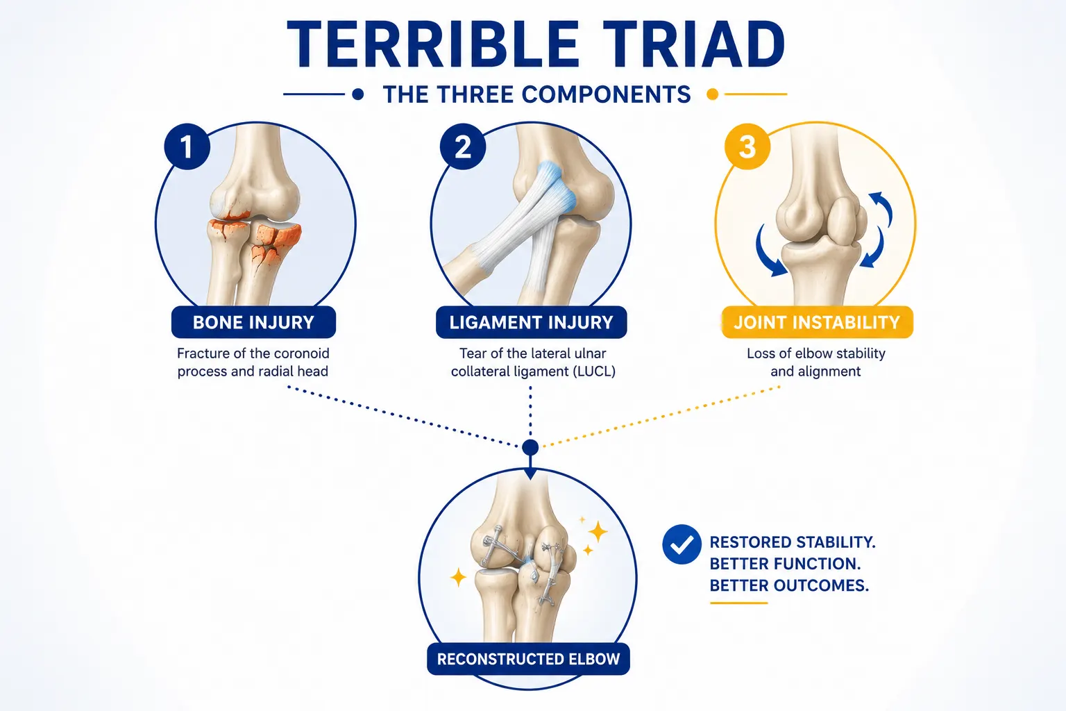 Infographic showing the three components addressed in terrible triad elbow reconstruction surgery. Best orthopaedic surgeon in Delhi NCR