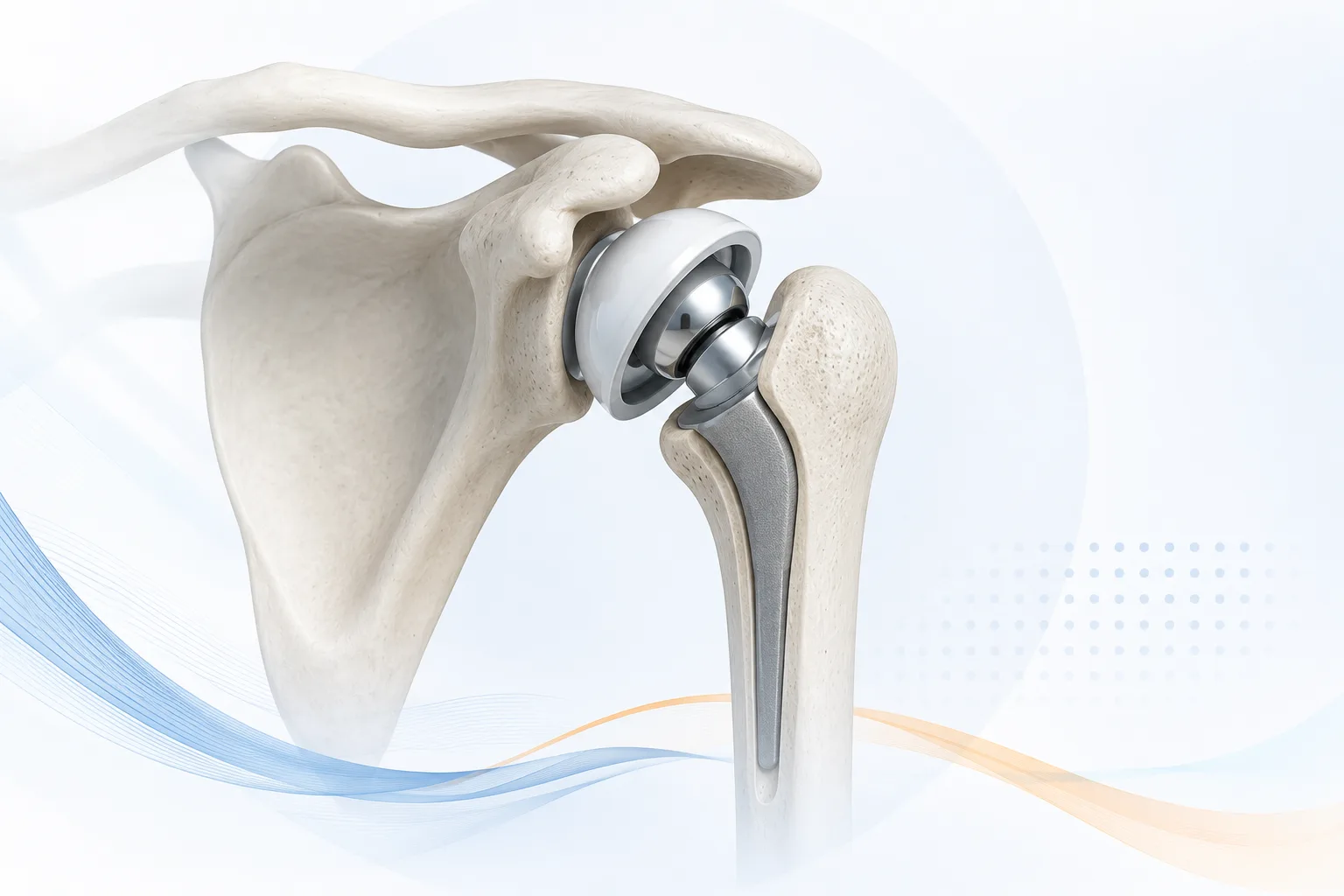 Revision Shoulder replacement Surgery in Gurgaon. Best Orthopaedic surgeon in Gurgaon