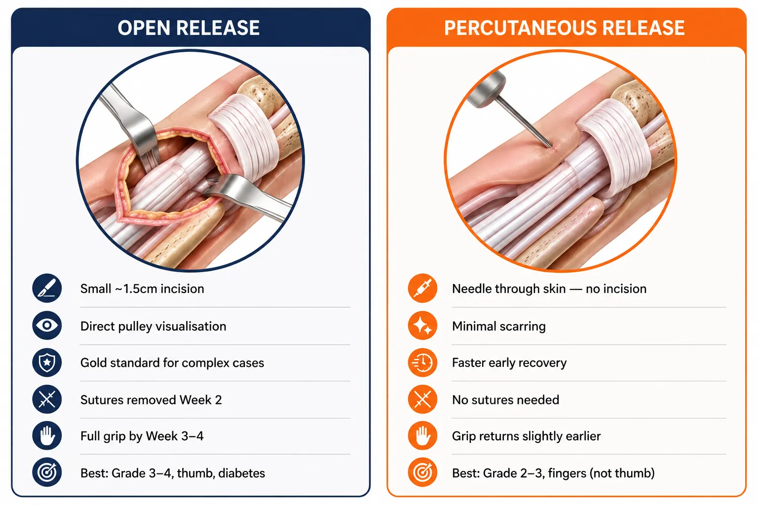 Open release versus percutaneous release for trigger finger, comparing incision, pulley visualisation, recovery, sutures and suitable cases.