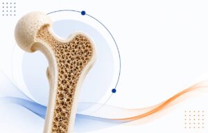 Osteoporosis Treatment: Medicines, Diet, Exercise & Prevention