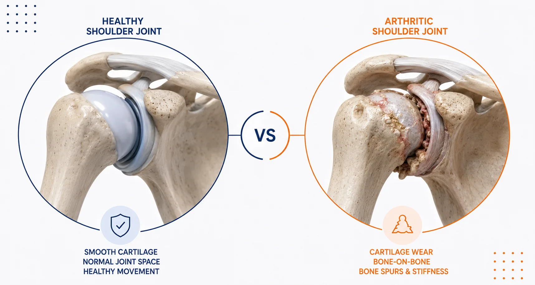 Shoulder Arthritis infographic
