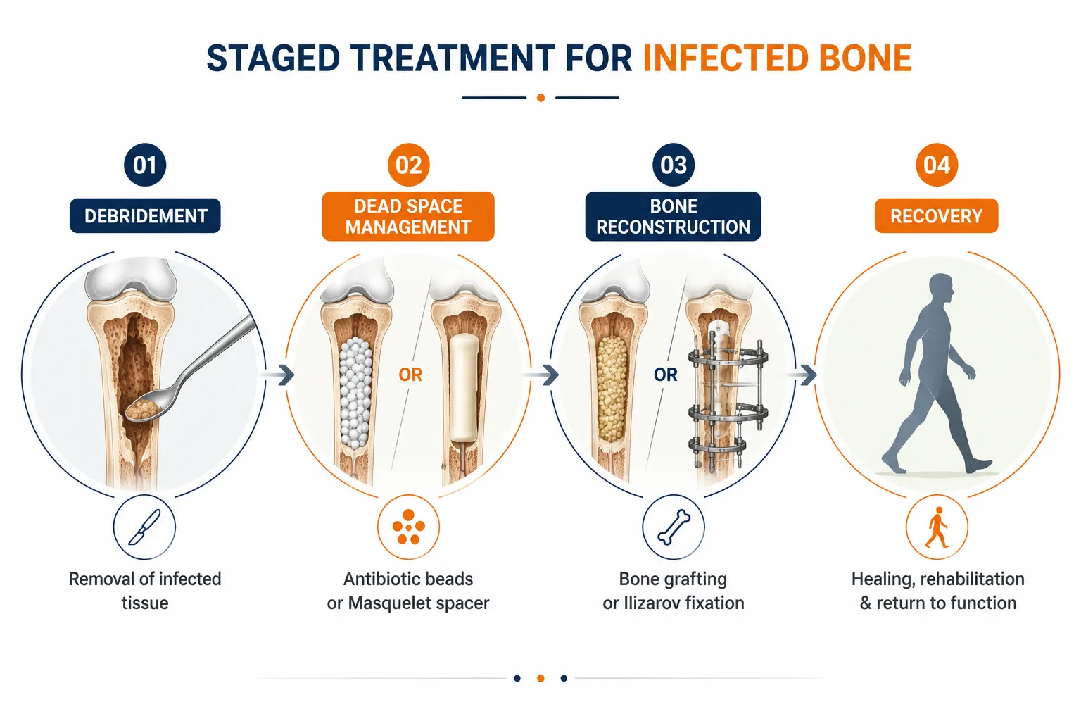 Infographic showing stages of chronic osteomyelitis surgical treatment
