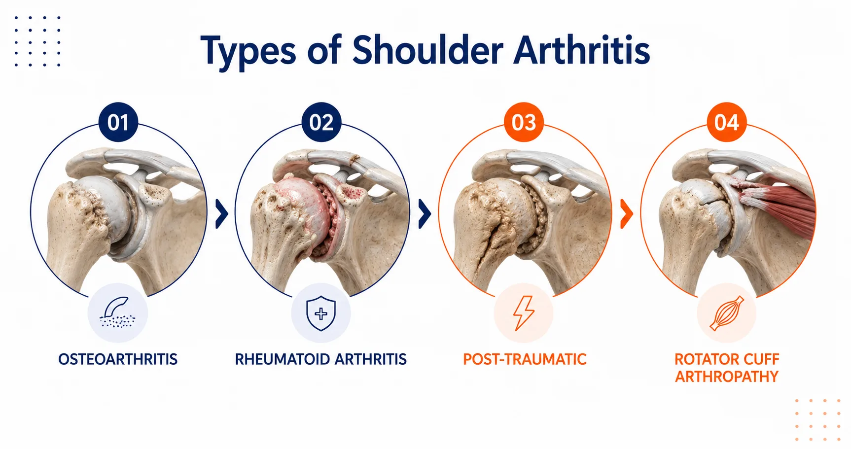 Types of Shoulder Arthritis shown as a infographic