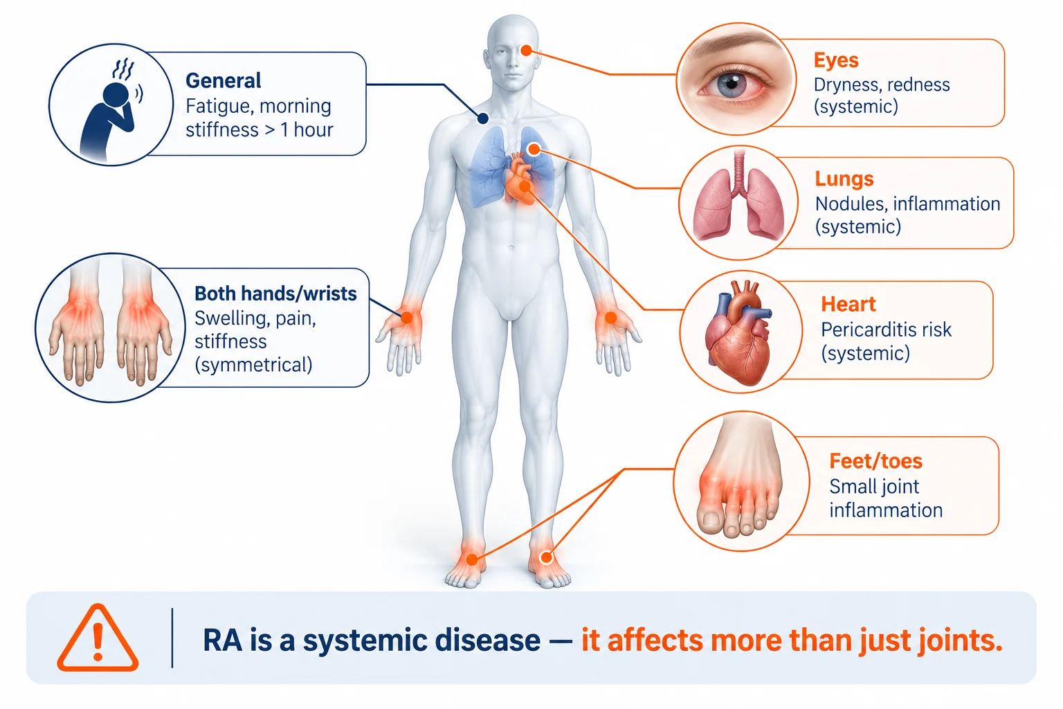 Rheumatoid arthritis symptoms infographic showing symmetrical hand and wrist inflammation, feet and toe joint swelling, eye dryness, lung inflammation, heart involvement, fatigue and morning stiffness.