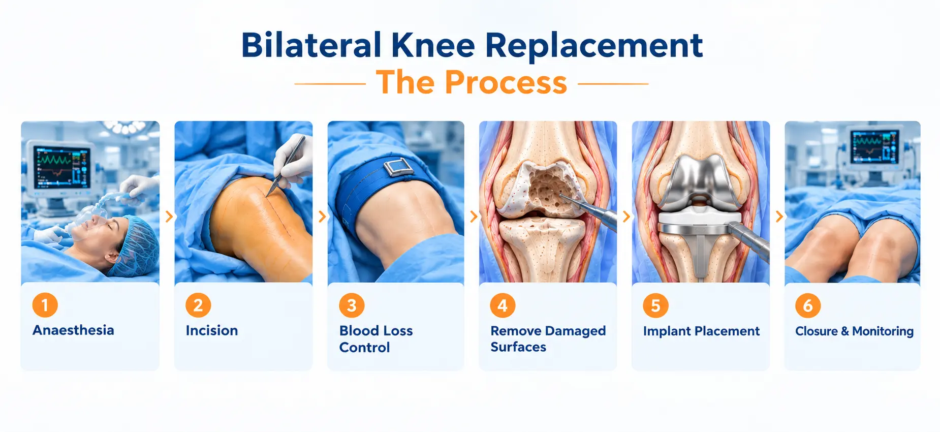 Bilateral knee replacement surgery procedure / Double Knee replacement surgery procedure showing anaesthesia, knee incision, blood loss control, removal of damaged knee surfaces, implant placement, and closure and monitoring.