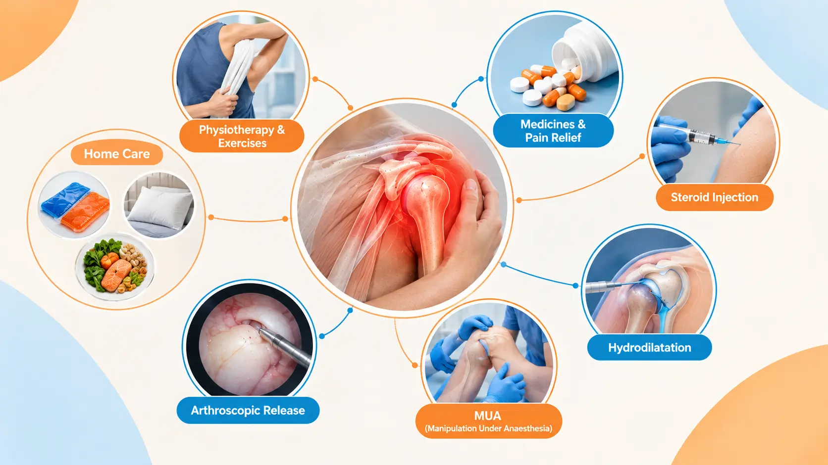 Frozen shoulder (फ्रोजन शोल्डर / एडहेसिव कैप्सूलाइटिस) के उपचार का मेडिकल चित्र, जिसमें दर्द और सूजन वाले shoulder joint (कंधे के जोड़) के साथ physiotherapy, medicines, steroid injection, hydrodilatation, arthroscopic release और home remedies को blue-orange medical theme में दिखाया गया है।