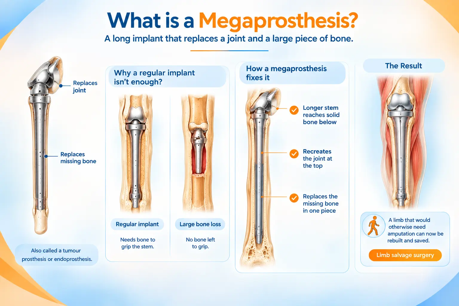 Megaprosthesis for major bone loss, showing how a long implant replaces missing bone and joint for limb salvage surgery.